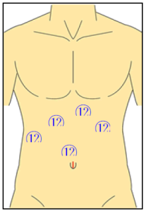 腹腔鏡下肝切除術創の画像