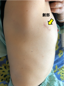 図1;単孔式胸腔鏡肺癌手術