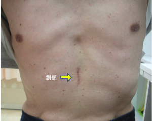 図5:単孔式剣状突起下胸腔鏡縦隔腫瘍手術