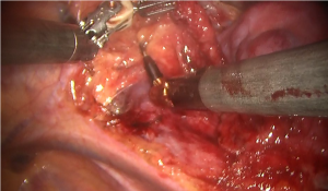 図6:ロボット拡大胸腺摘出術