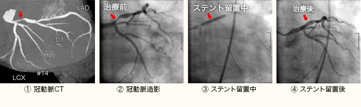 冠動脈CT
