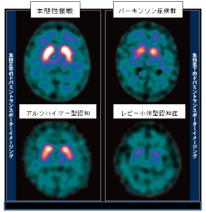 本態性振戦 パーキンソン症候群 アルツハイマー型認知 レビー小体型認知症